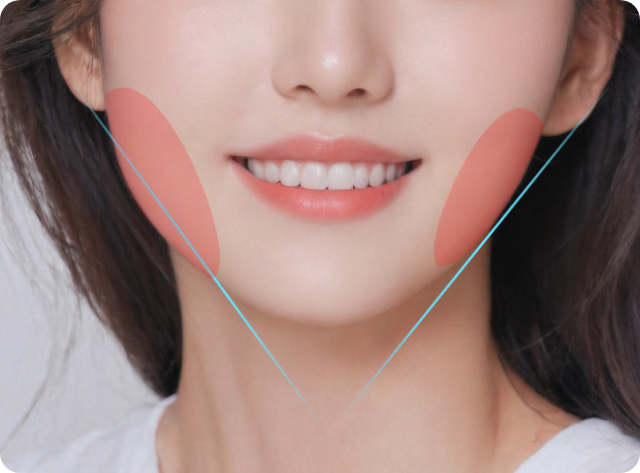 보톡스